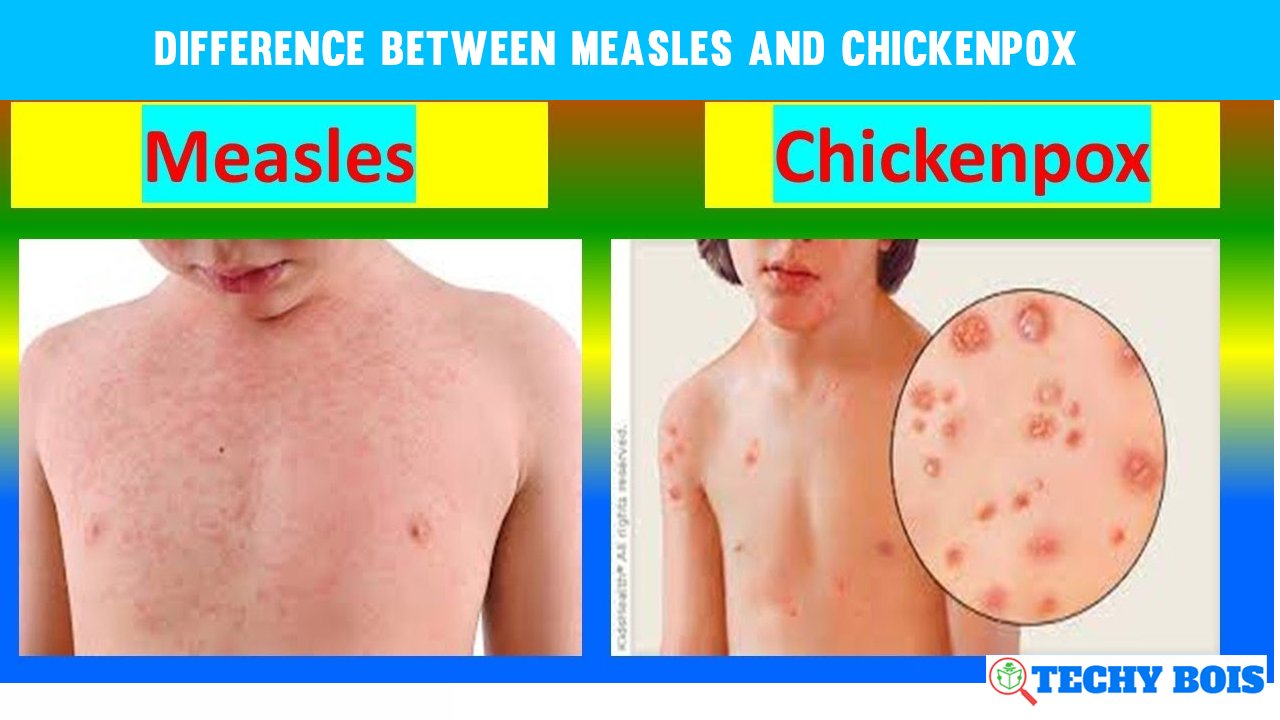 Difference between measles and chickenpox